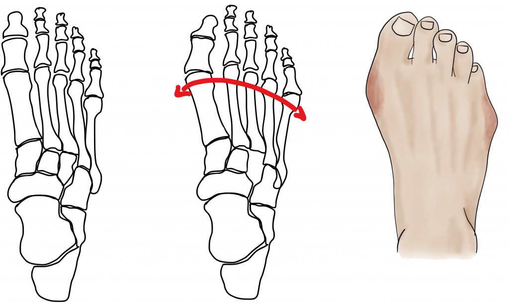 Themenschwerpunkt Spreizfuß - Produktbild